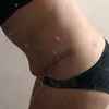 Flacidez después de Abdominoplastia a los 7 meses