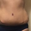 Rollitos en las caderas después de abdominoplastia