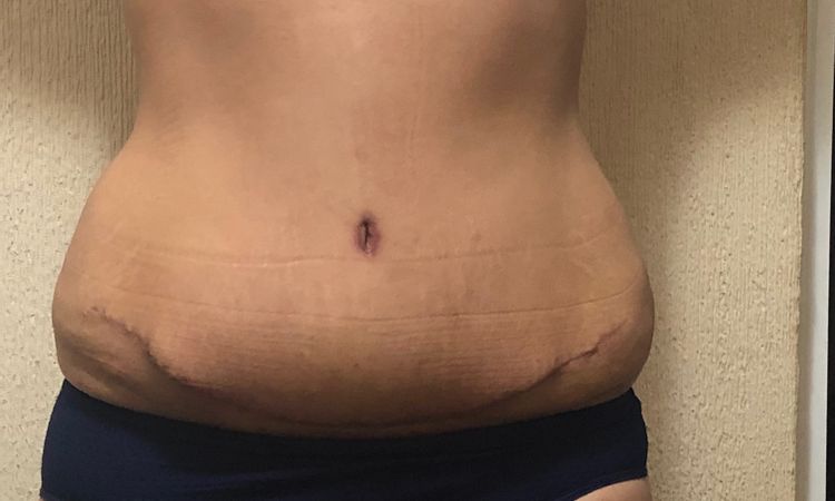 Rollitos en las caderas después de abdominoplastia - 8557