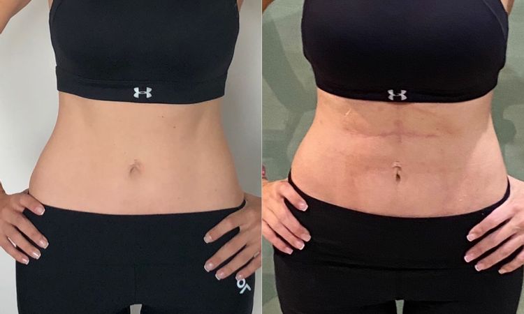 Fibrosis después de lipo vaser - 8794