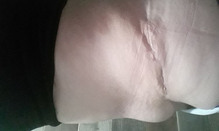 Panza colgando después de 3 meses de abdominoplastia - 12096