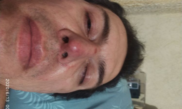 Me realice una rinomodelacion con ácido hialurónico - 12319