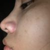 Inflamacion, dolor de nariz y un golpe - 12456