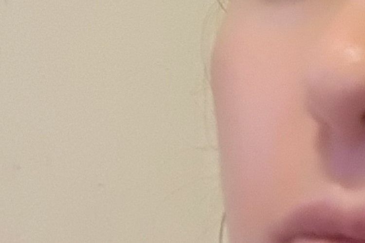 Revertir acido hialuronico con hialuronidasa