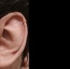 Reducción de tamaño de oreja y concha - 14977