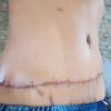 Método para eliminar la cicatriz de abdominoplastia y mastopexia