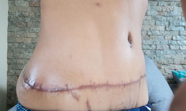 Método para eliminar la cicatriz de abdominoplastia y mastopexia - 15593