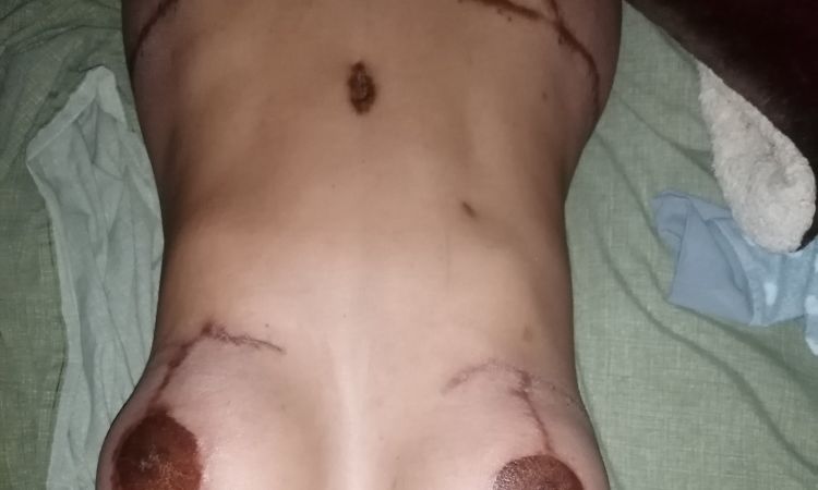 ¿Se puede volver a tener erección en los pezones? - 15839