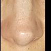 Corrección de punta en nariz escudo tipo sheen (