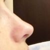 Ayuda!! Veo algo raro en mi nariz después de rinoplastia - 16198