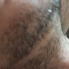 Sobre zona de alopecia debajo de mentón, después de una lipopada