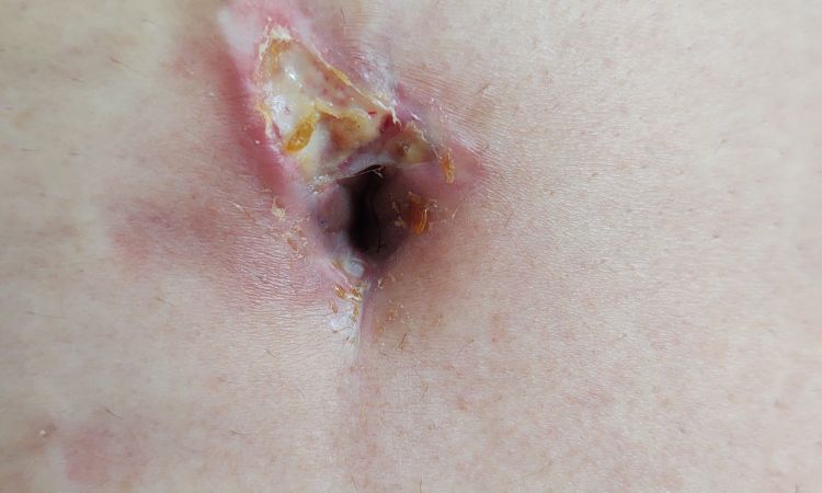 Mi ombligo tenga fibrina después de 4 semanas de mi abdominoplastia - 41888