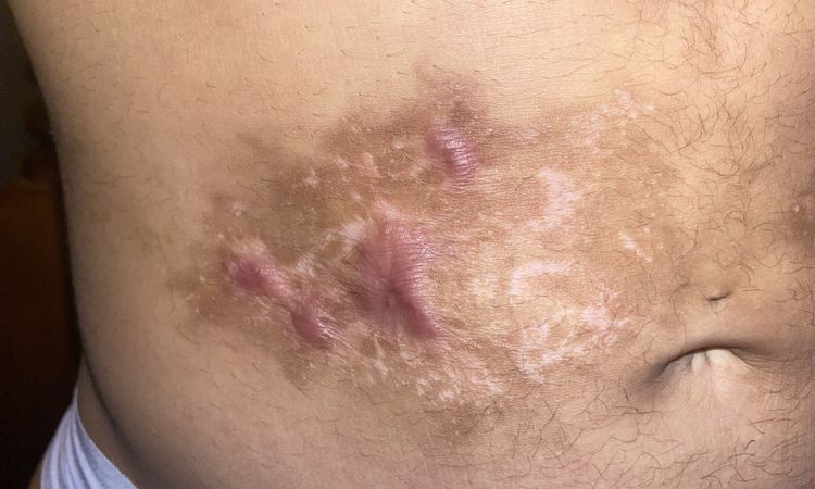 Quemadura por canula de liposuccion - 42201