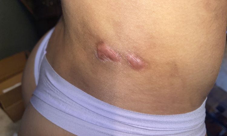 Quemadura por canula de liposuccion - 42202