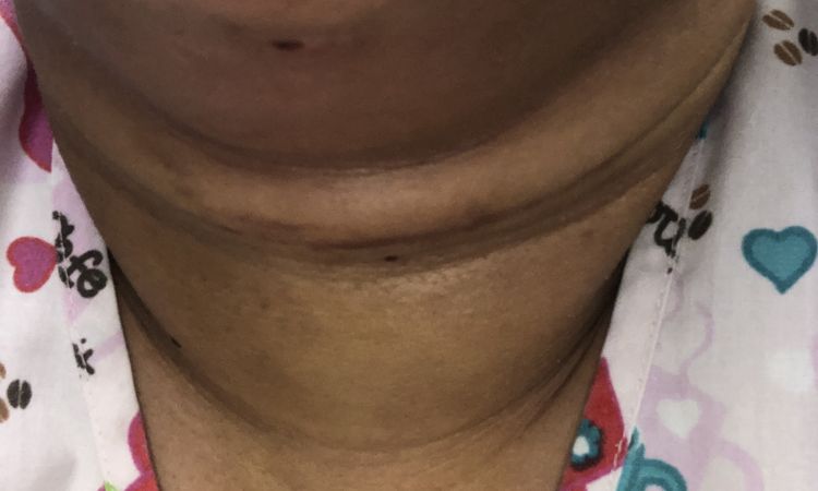 Lipo de papada y marcacion mandibular - 43530