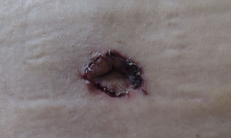 Mi ombligo no sana tras una abdominoplastia - 43689