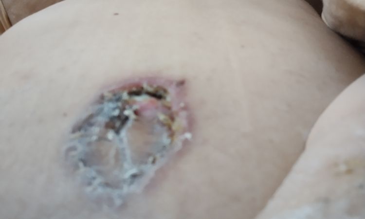 Mi ombligo no sana tras una abdominoplastia - 43690