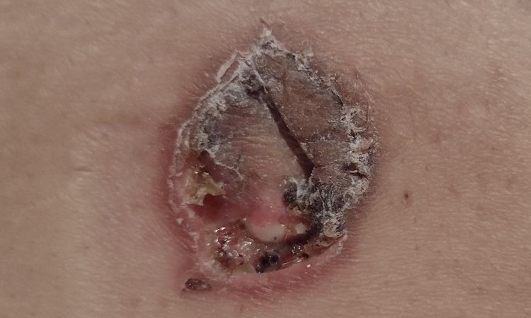 Mi ombligo no sana tras una abdominoplastia - 43691