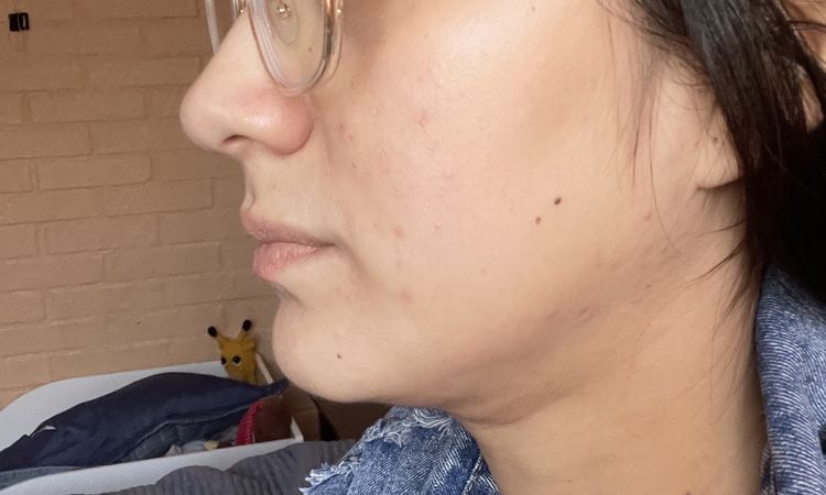 Lipo papada más de un mes - 43761