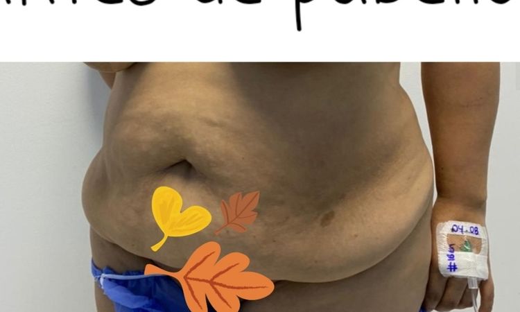 Cicatriz de abdominoplastia irregular - 43885