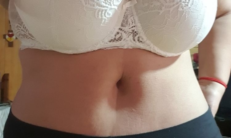 Cicatriz de abdominoplastia irregular - 43886