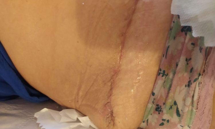 Cicatriz de abdominoplastia irregular - 43887