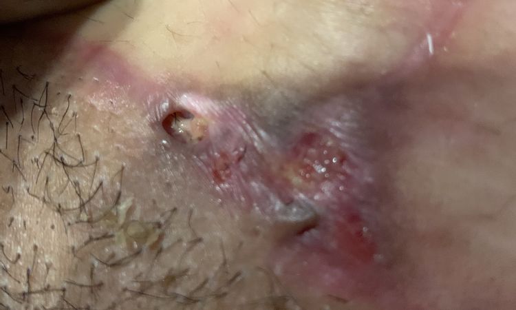 Herida abierta em abdominoplastia de 8 semanas - 44059