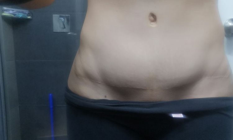 1.5 años de operada y parta baja del abdomen sigue inflamada - 44138