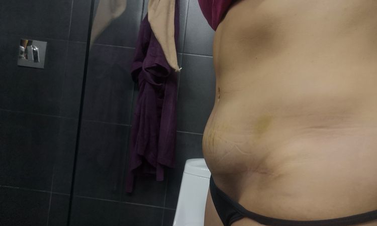 1.5 años de operada y parta baja del abdomen sigue inflamada - 44139