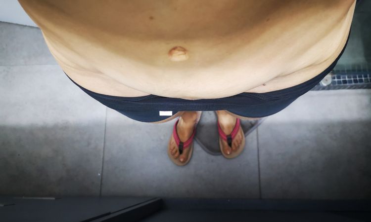 1.5 años de operada y parta baja del abdomen sigue inflamada - 44141