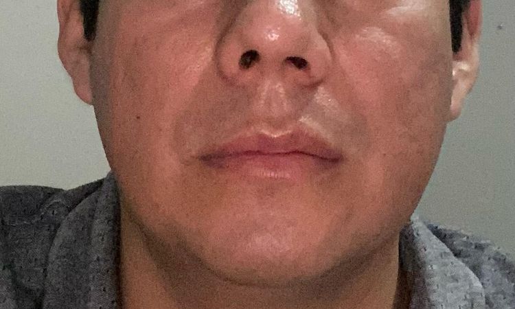 Rinoplastia hace un mes y fosas nasales asimétricas - 44750