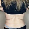 Revisión de lipo con fibrosis, flacidez y exceso de grasa en espalda alta - 44857