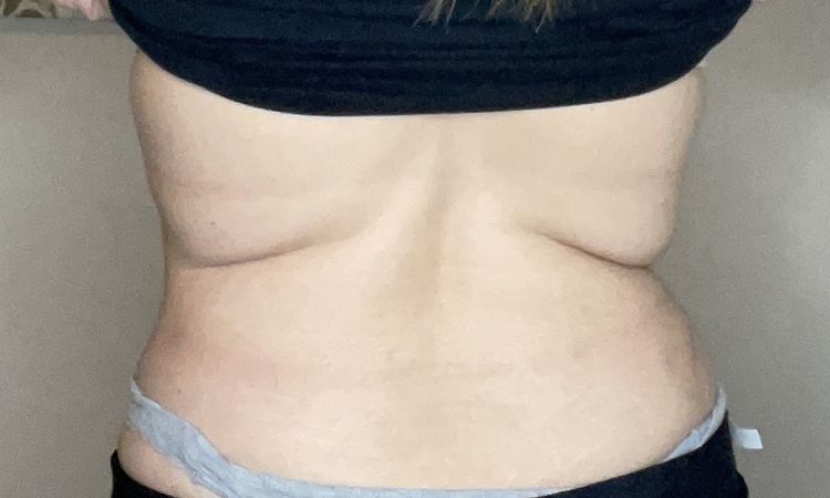 Revisión de lipo con fibrosis, flacidez y exceso de grasa en espalda alta - 44857