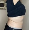 Revisión de lipo con fibrosis, flacidez y exceso de grasa en espalda alta
