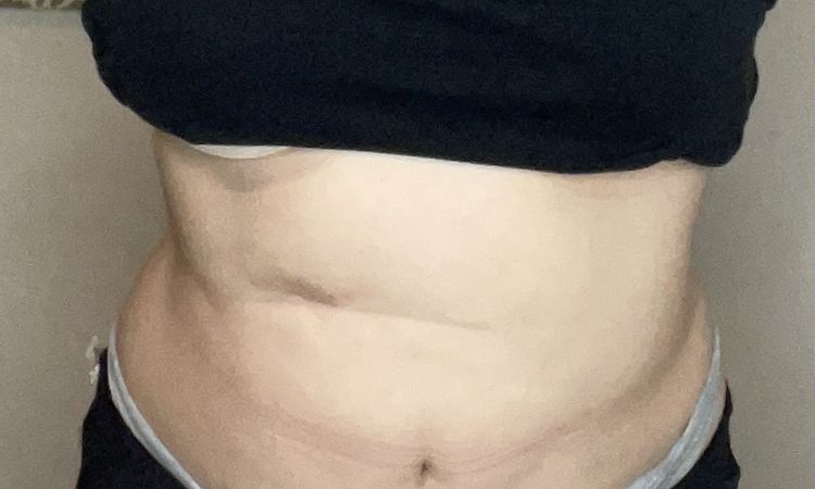 Revisión de lipo con fibrosis, flacidez y exceso de grasa en espalda alta - 44859