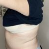 Revisión de lipo con fibrosis, flacidez y exceso de grasa en espalda alta - 44860