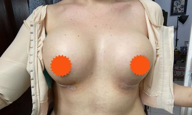Tiempo para retirar los implantes por exceso de tamaño - 44959