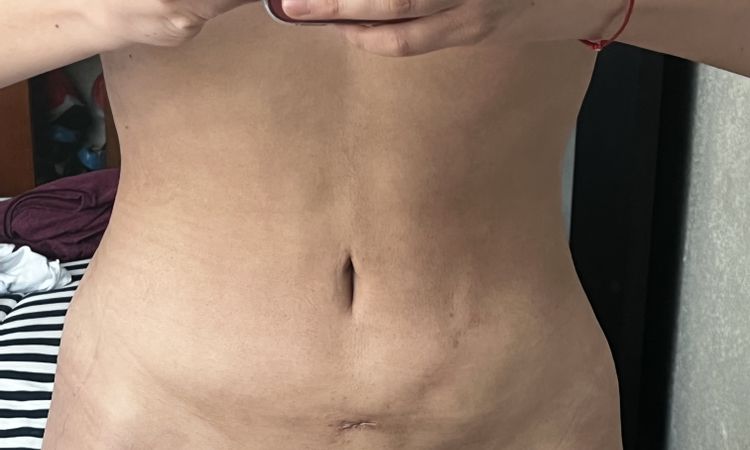 Irregularidades en abdomen postlipo - 45311