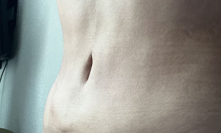 Irregularidades en abdomen postlipo - 45312