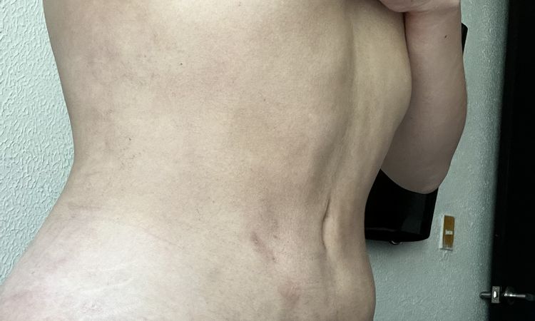 Irregularidades en abdomen postlipo - 45313