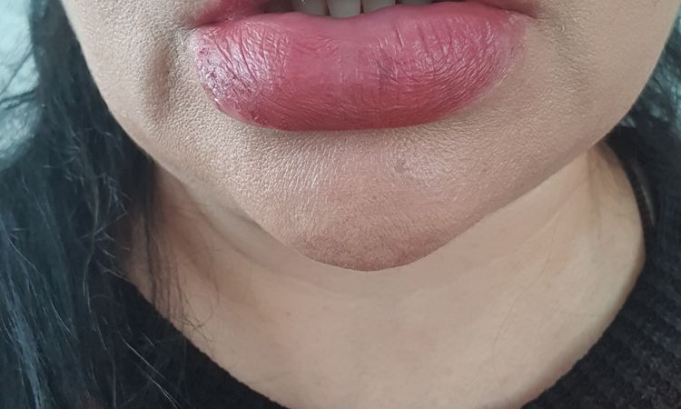 Reducir labio aumentado con "acido Hialurónico" pero que no lo es - 45416