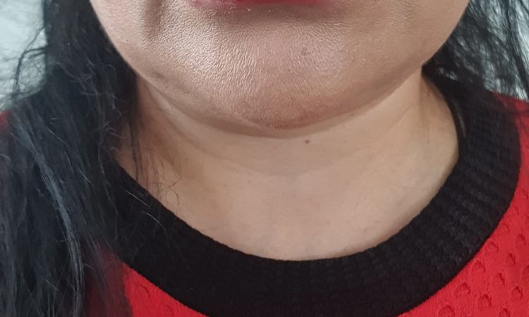 Reducir labio aumentado con "acido Hialurónico" pero que no lo es - 45417