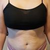 Soy candidata a liposucción sin lipectomia?