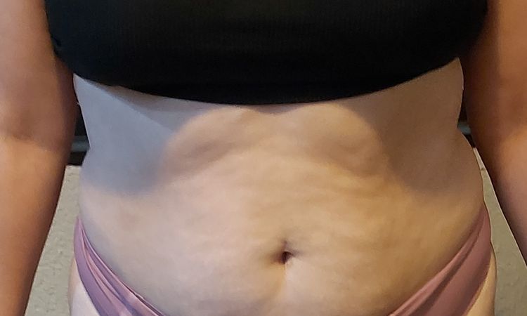Soy candidata a liposucción sin lipectomia? - 45466