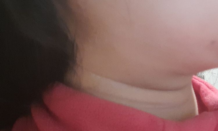 ME HICE LA LIPOPAPADA 2 VECES Y TENGO PIEL COLGANTE - 45581