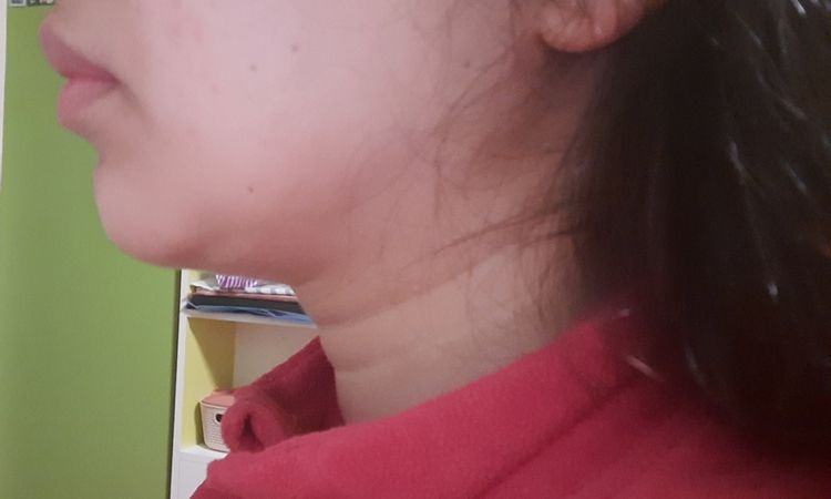 ME HICE LA LIPOPAPADA 2 VECES Y TENGO PIEL COLGANTE - 45582