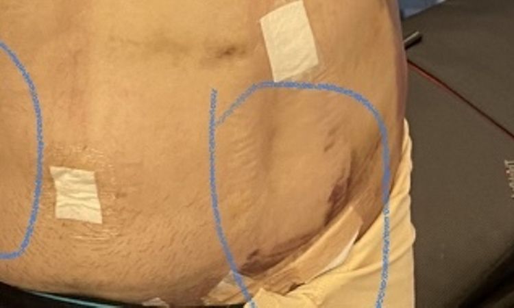 Líquido después de liposuccion - 45827