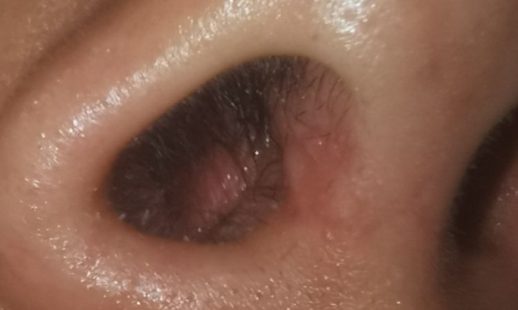 Fosas nasales desiguales 5 meses después de rinoplastia - 46084
