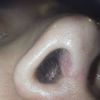 Fosas nasales desiguales 5 meses después de rinoplastia - 46085