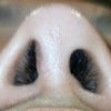 Fosas nasales desiguales 5 meses después de rinoplastia - 46087